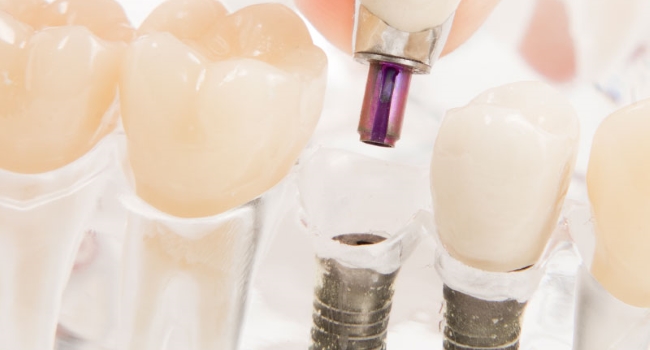 Implantat in einem Gebissmodell aus Acryl