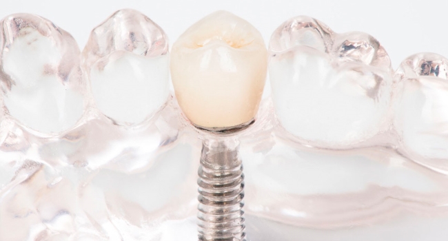 Zahnimplantate in Acryl-Gebissmodell