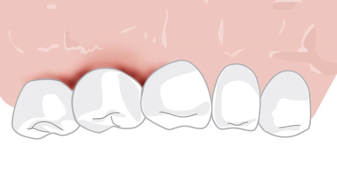 Grafik: Parodontitis, gerötetes Zahnfleisch