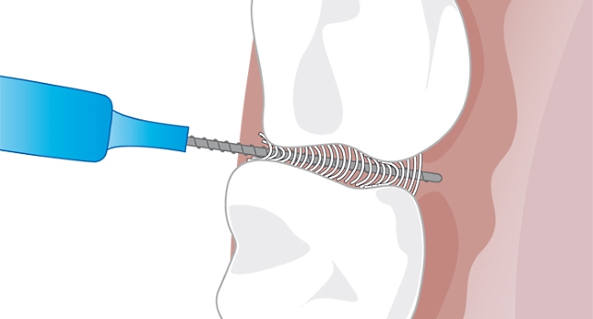 Grafik: Interdentalbürstchen