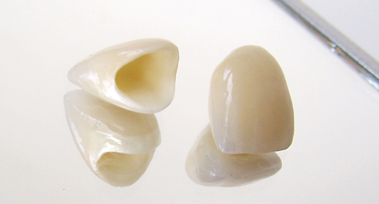 Vollkeramische Kronen auf Glasunterlage